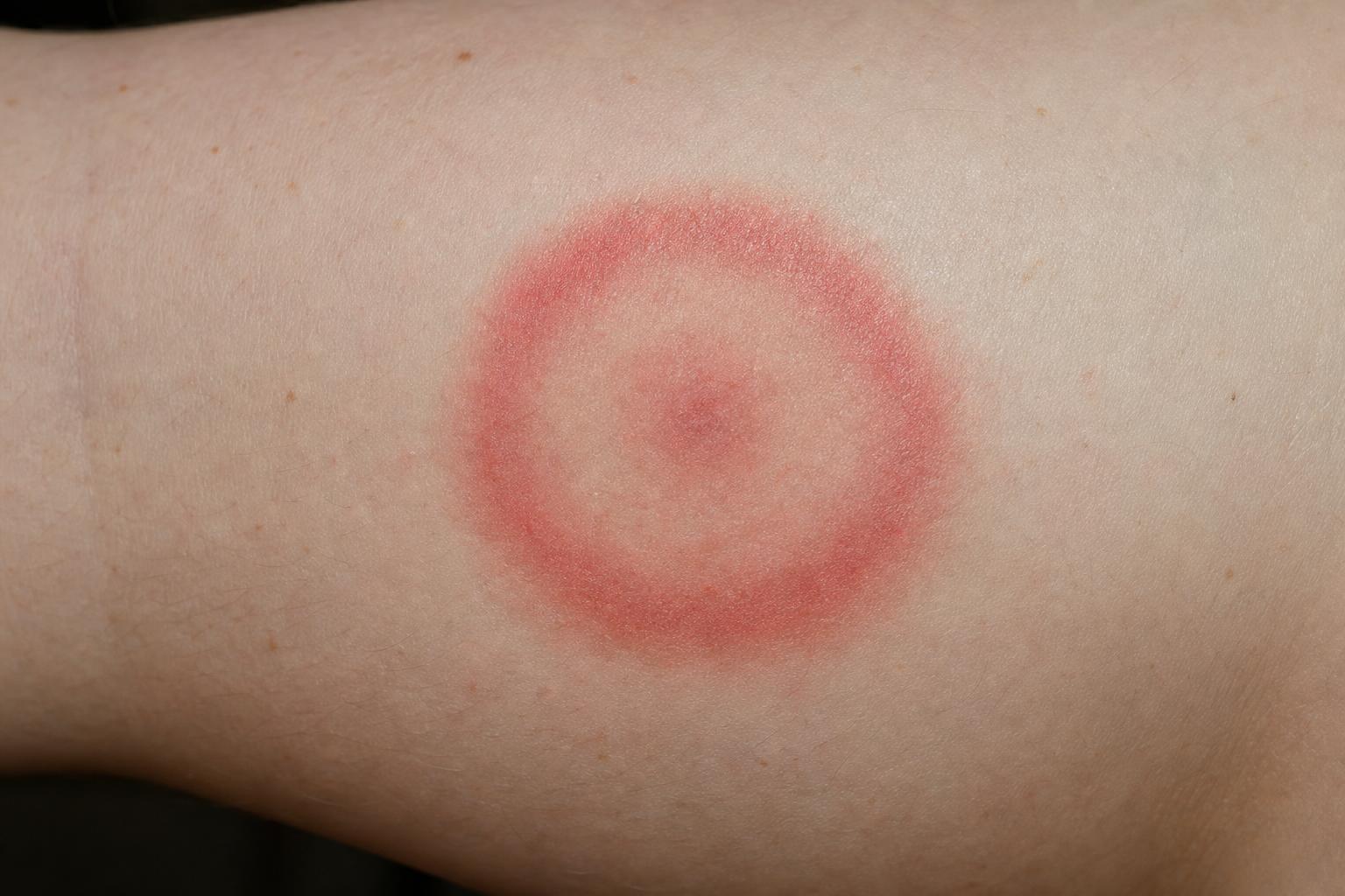 Erythema migrans bullseye rash from a Lyme disease tick bite