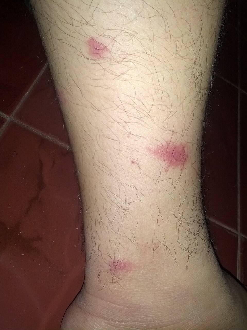 Mosquito bite welts on a person's leg